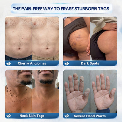 ✨✨𝐏𝐢𝐜𝐝𝐨® 7-𝐃𝐚𝐲 𝐒𝐤𝐢𝐧 𝐓𝐚𝐠 & 𝐒𝐩𝐨𝐭 𝐄𝐫𝐚𝐬𝐞𝐫 𝐂𝐫𝐞𝐚𝐦🩵 (Zero Pain, Zero 𝐒𝐜𝐚𝐫𝐬 Formula) 💪