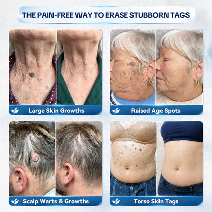 ✨✨𝐏𝐢𝐜𝐝𝐨® 7-𝐃𝐚𝐲 𝐒𝐤𝐢𝐧 𝐓𝐚𝐠 & 𝐒𝐩𝐨𝐭 𝐄𝐫𝐚𝐬𝐞𝐫 𝐂𝐫𝐞𝐚𝐦🩵 (Zero Pain, Zero 𝐒𝐜𝐚𝐫𝐬 Formula) 💪