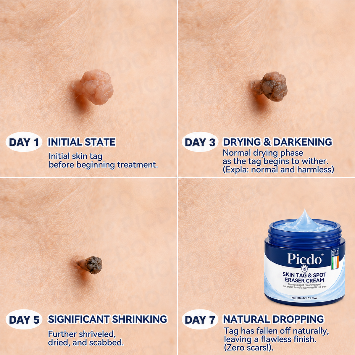 ✨✨𝐏𝐢𝐜𝐝𝐨® 7-𝐃𝐚𝐲 𝐒𝐤𝐢𝐧 𝐓𝐚𝐠 & 𝐒𝐩𝐨𝐭 𝐄𝐫𝐚𝐬𝐞𝐫 𝐂𝐫𝐞𝐚𝐦🩵 (Zero Pain, Zero 𝐒𝐜𝐚𝐫𝐬 Formula) 💪