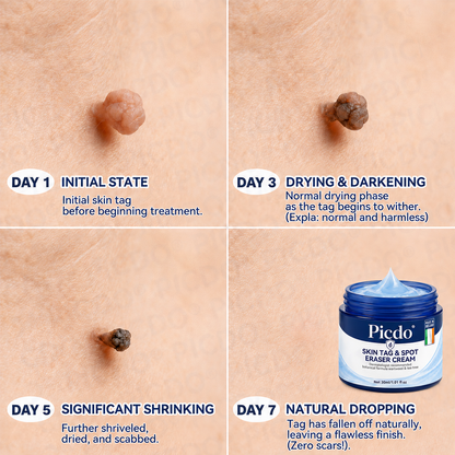 ✨✨𝐏𝐢𝐜𝐝𝐨® 7-𝐃𝐚𝐲 𝐒𝐤𝐢𝐧 𝐓𝐚𝐠 & 𝐒𝐩𝐨𝐭 𝐄𝐫𝐚𝐬𝐞𝐫 𝐂𝐫𝐞𝐚𝐦🩵 (Zero Pain, Zero 𝐒𝐜𝐚𝐫𝐬 Formula) 💪